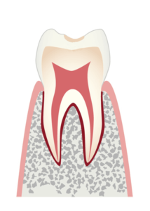 歯の表面のむし歯