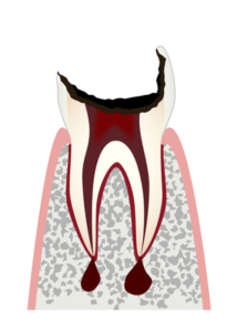 歯の根っこだけが残った状態