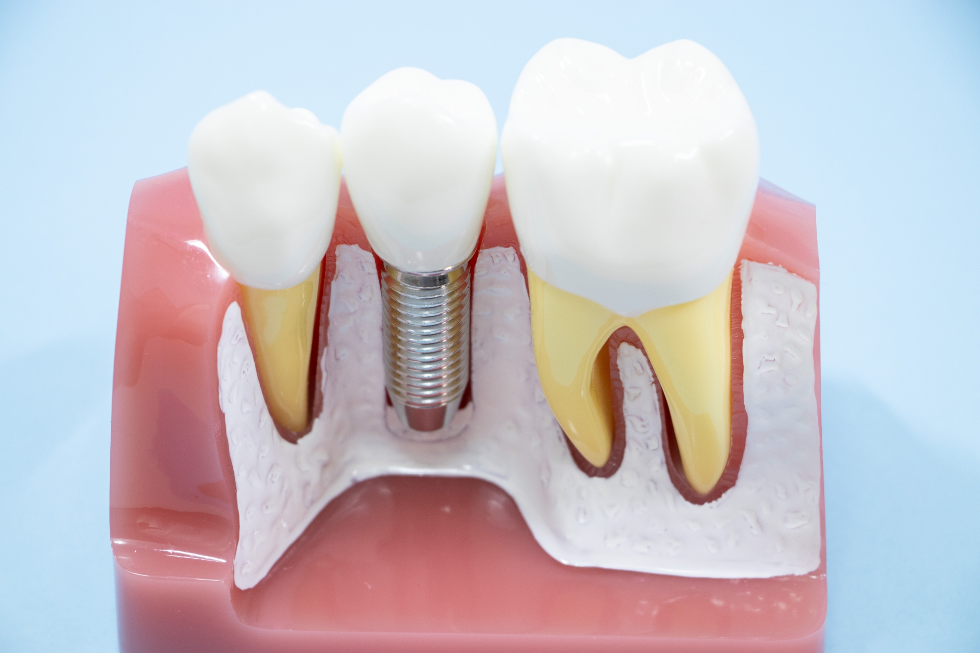 インプラントと骨の結合