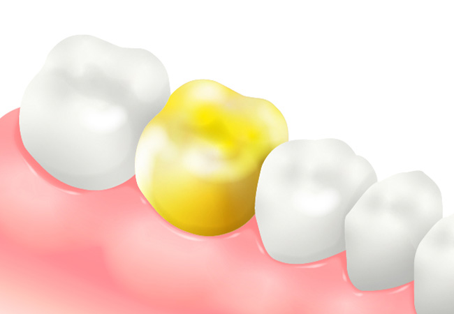 ゴールドクラウン