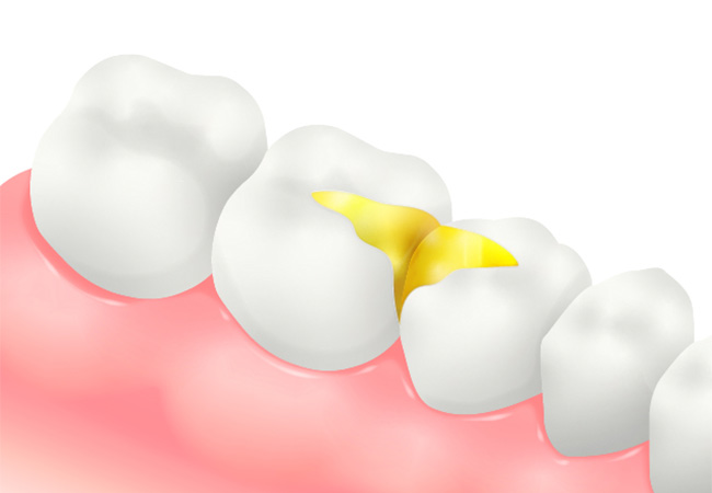 ゴールドインレー